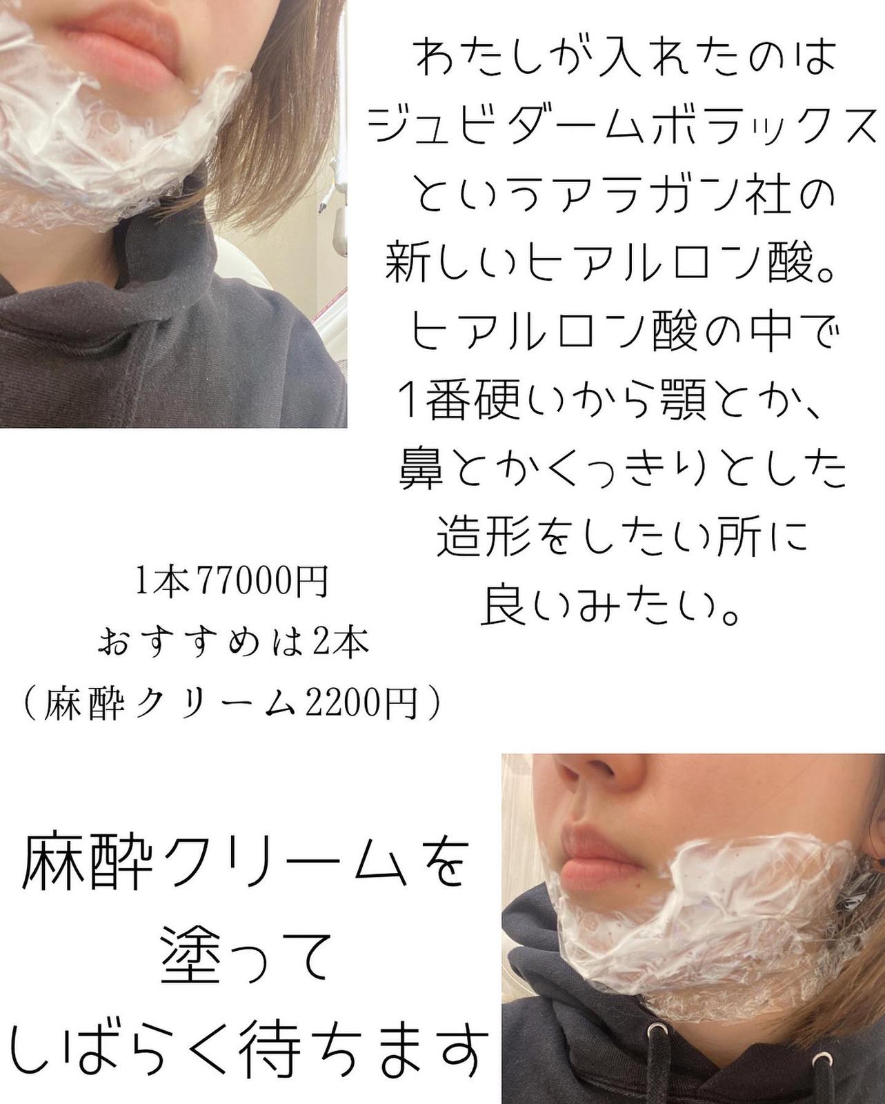 本当にやって良かった美容医療 顎ヒアルロン酸注入 Ritu Cosmeが投稿したフォトブック Lemon8