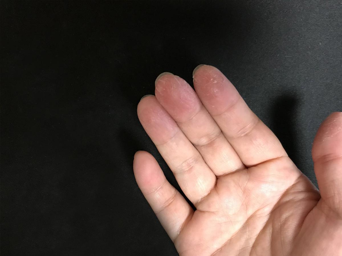 なかなか治らない指先の荒れ何とかしたい時のお助け指サック Yuuuuyaが投稿した記事 Lemon8