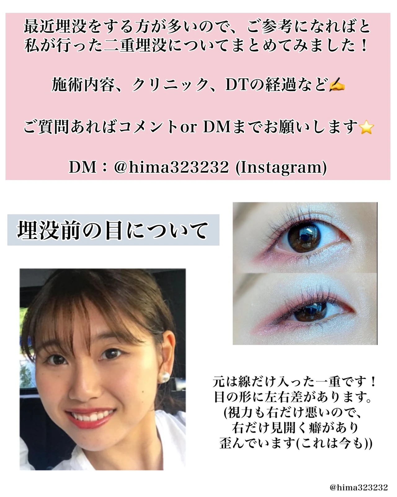 整形 私が施術した二重埋没について Hima 垢抜けアイメイクが投稿したフォトブック Lemon8