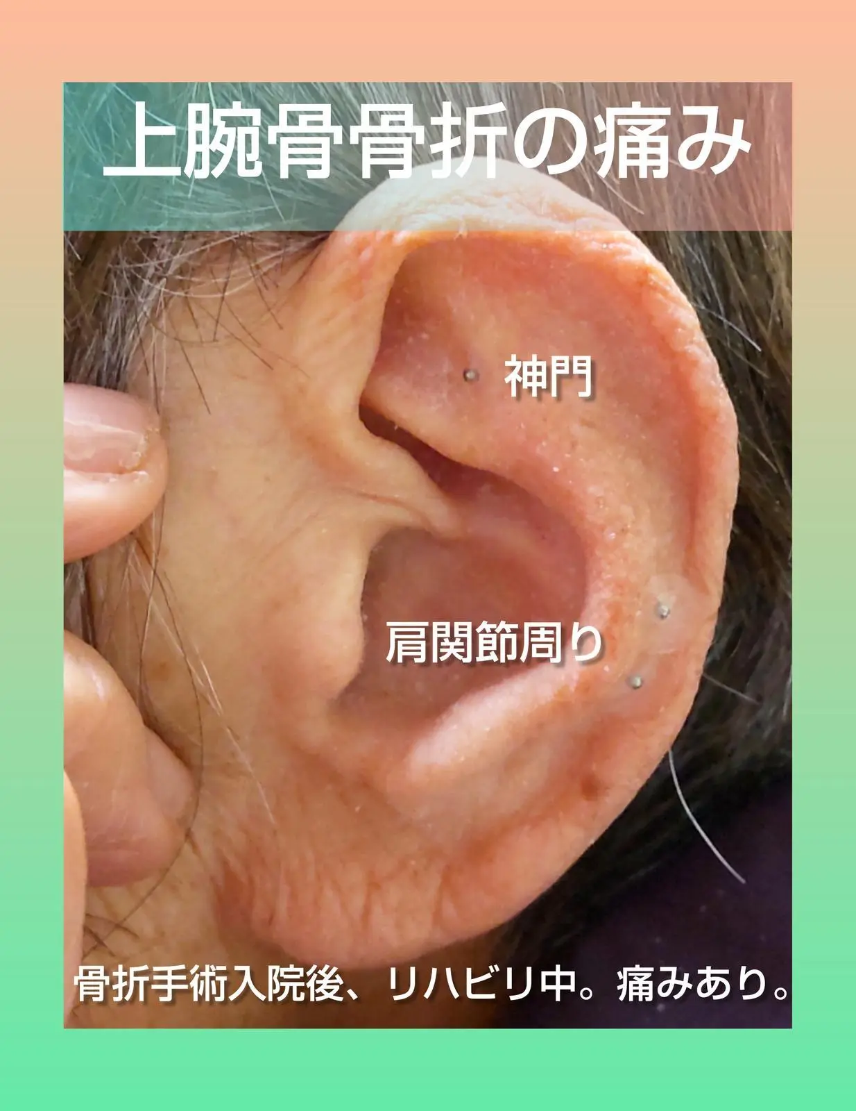 🟪痛みに特化した耳つぼの画像 (1枚目)