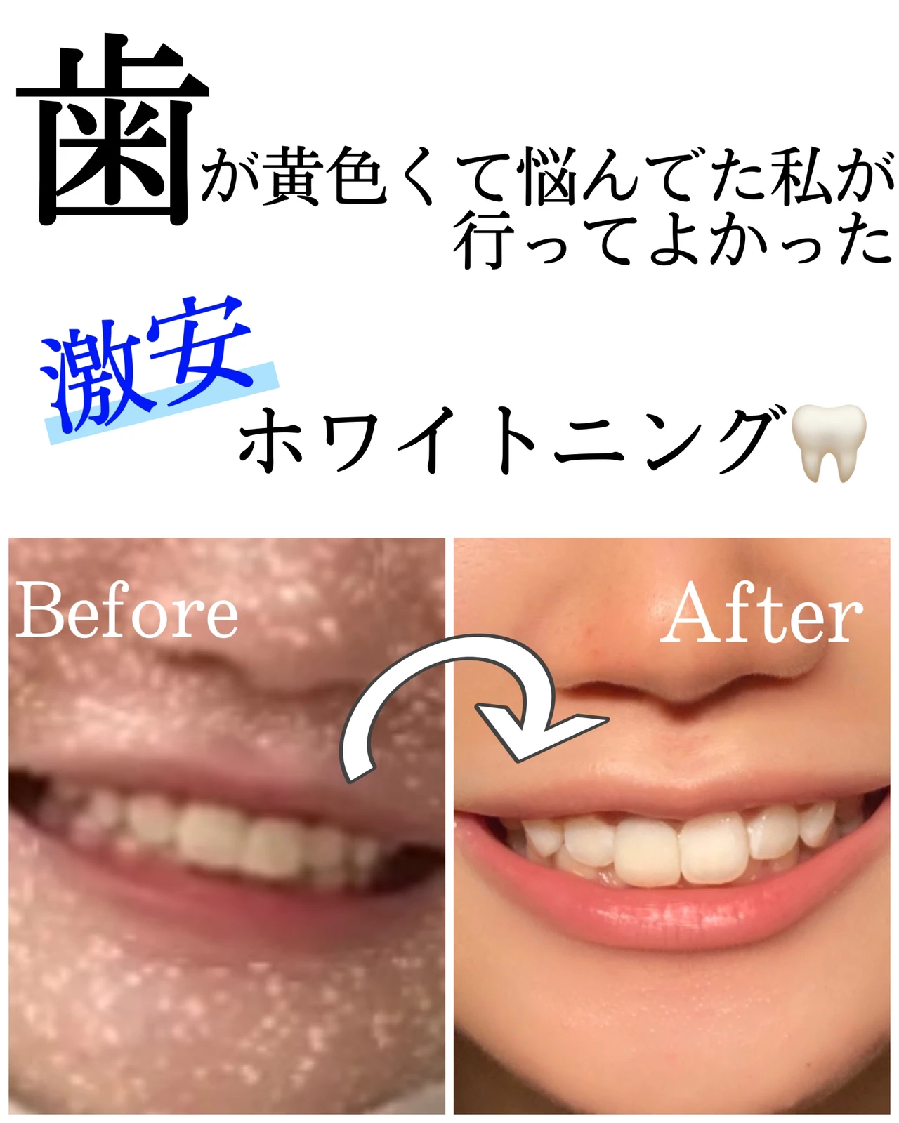 簡単ホワイトニング Lemon8 簡単ホワイトニング Lemon8