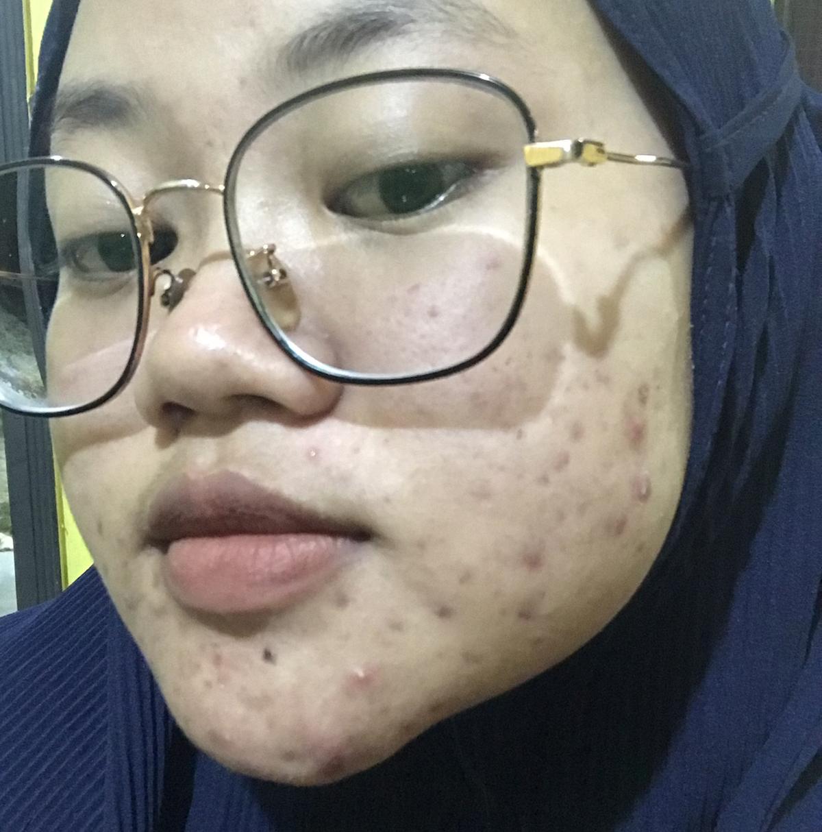 Acne fighter:)'s Post|Lemon8