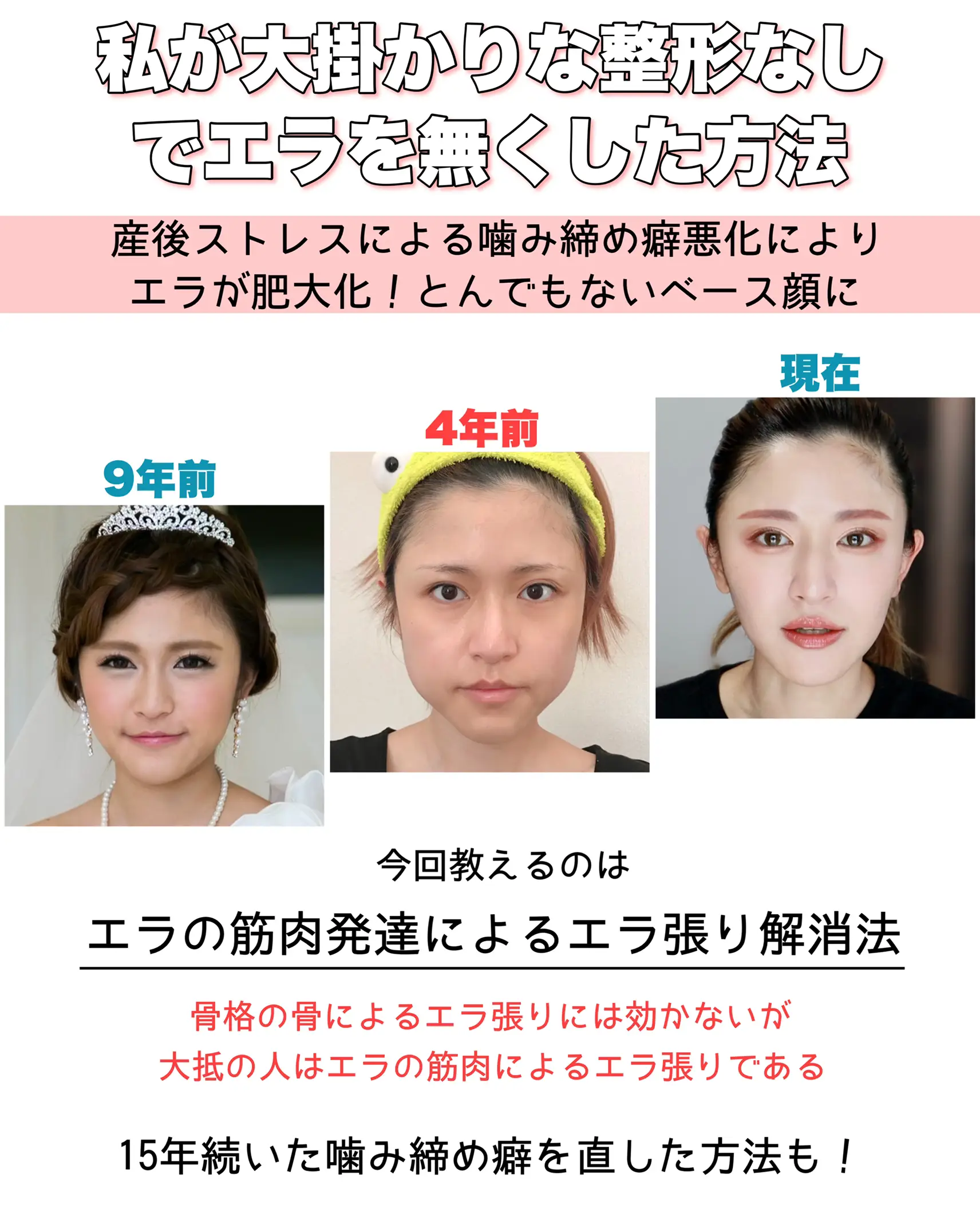 エラをなくした方法 15年悩んだ噛み締め癖解消法も とみりーが投稿したフォトブック Lemon8