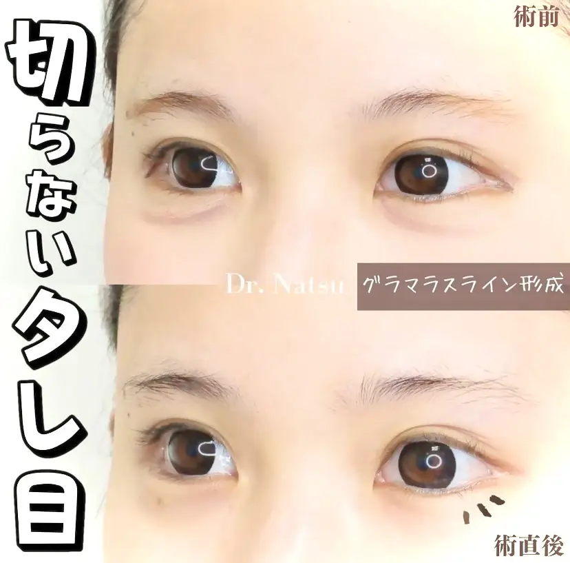 タレ目にする マッサージ Lemon8